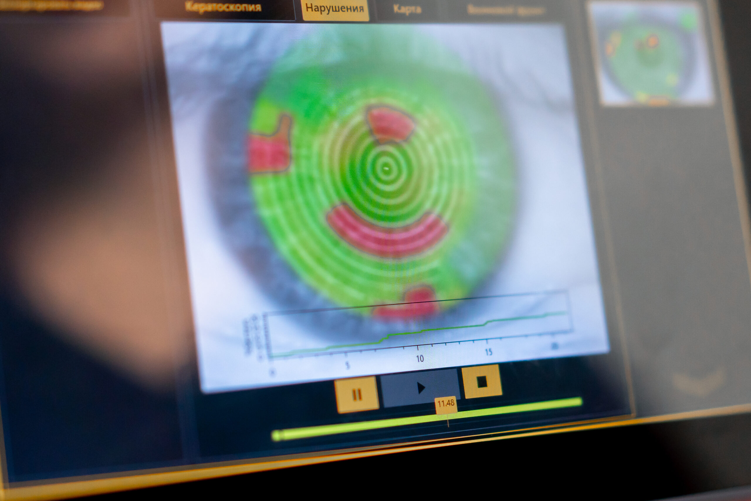 Topografia corneale a Roma